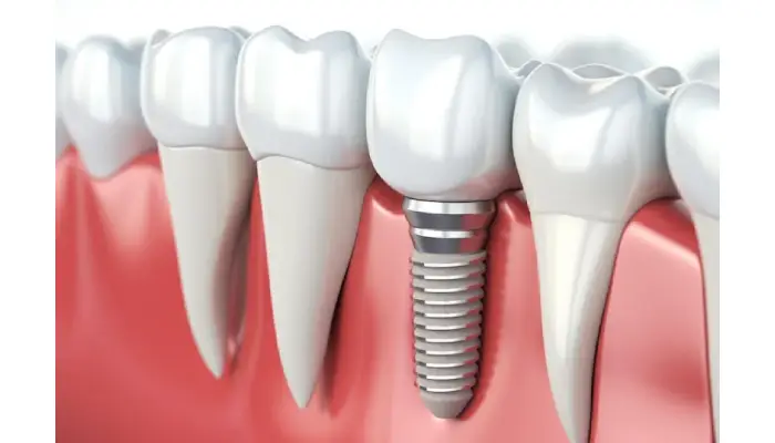 Discover The Benefits Of Dental Implants In Pembroke Pines, FL