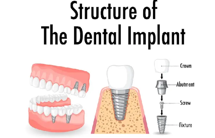 all-on-x dental implants pembroke pines