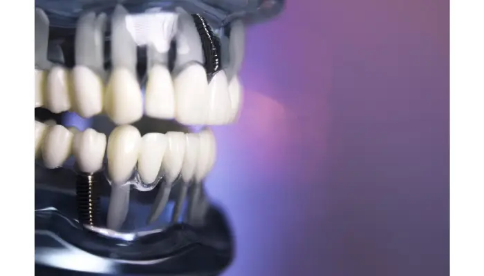 How to Care for All on 4 Dental Implants in Pembroke Pines?