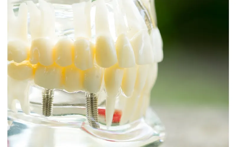 How to Care for Your All on 4 Dental Implants in Pembroke Pines?